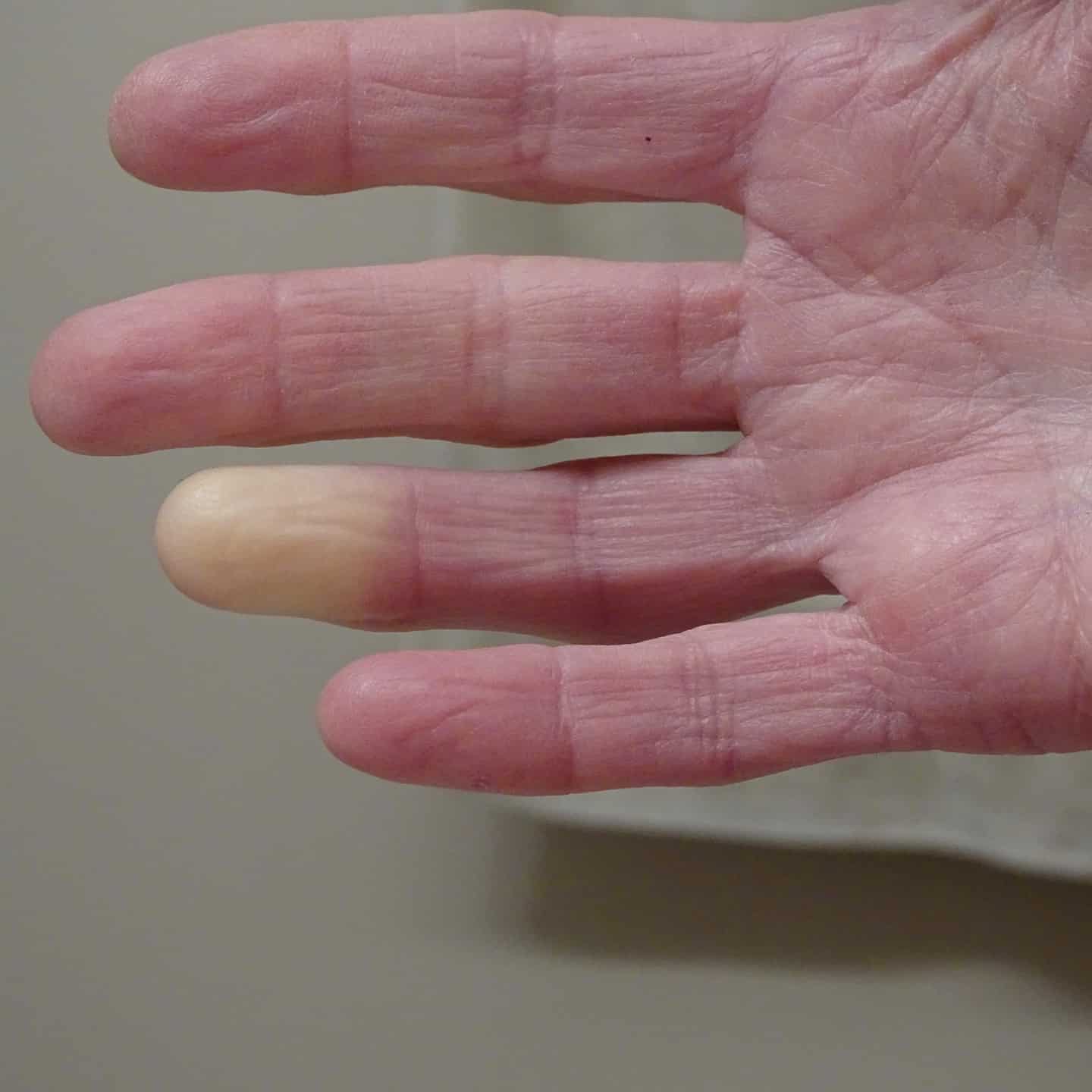 scleroderma-skin-complications-and-treatments-raynaud-s-phenomenon