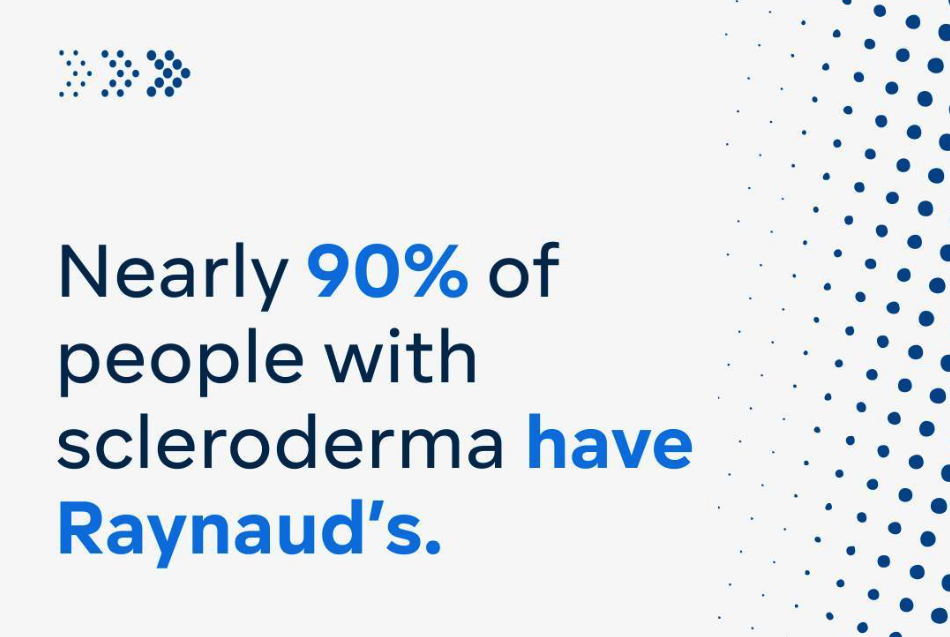 Nearly 90% of people with scleroderma have Raynaud's.